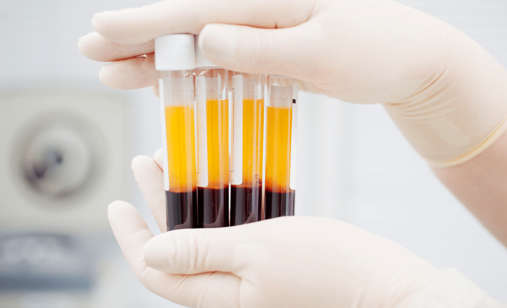 Blodplaterikt plasma for PRP-behandling for artrose